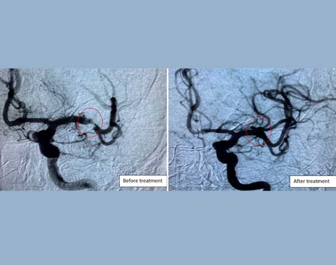 Brain scan comparison before and after treatment